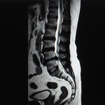 Sagittal view of a lumbar spine MRI scan showing intervertebral discs and vertebrae.