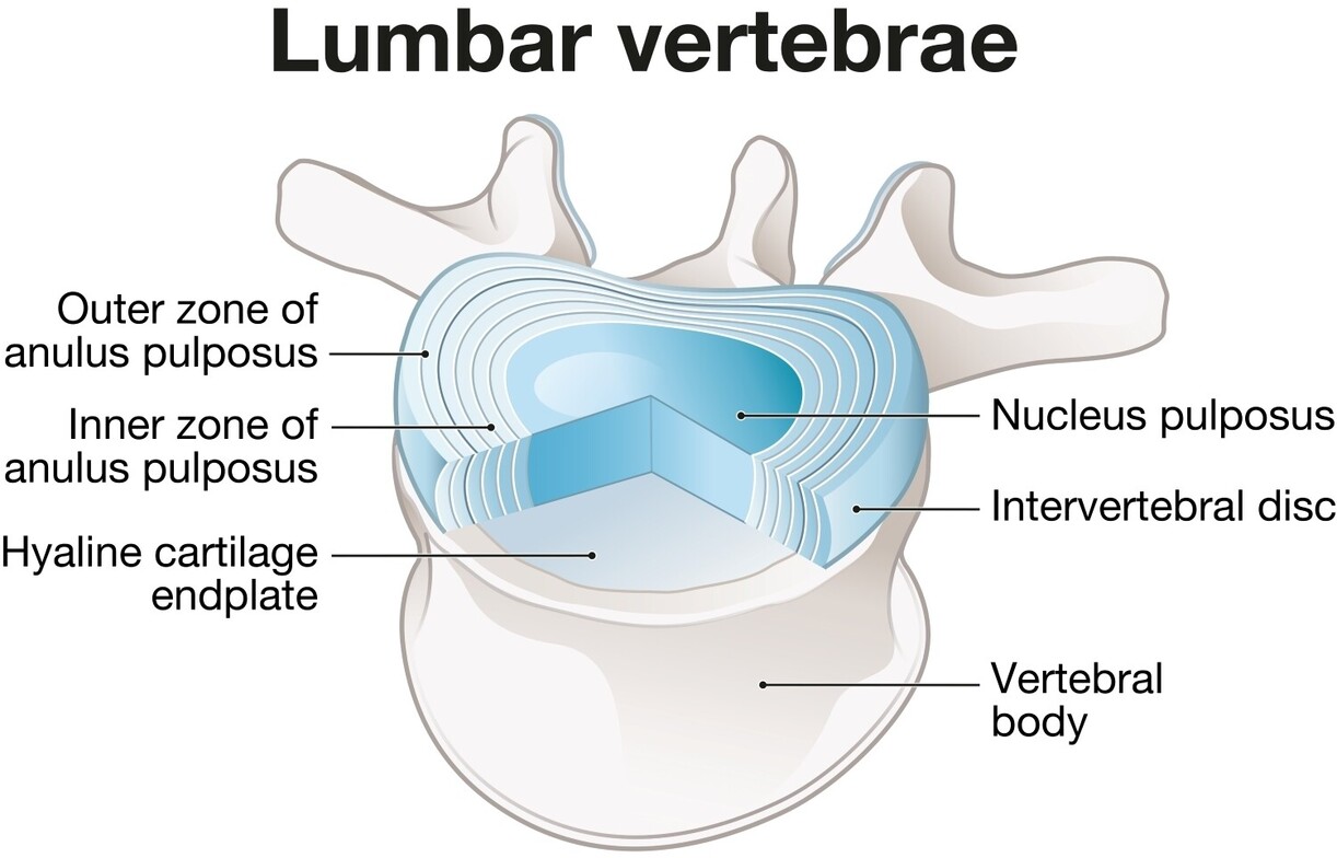 Anatomical diagram of a lumbar vertebra, labeling the nucleus pulposus, annulus fibrosus, and intervertebral disc components.
