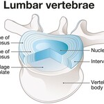 Anatomical diagram of a lumbar vertebra, labeling the nucleus pulposus, annulus fibrosus, and intervertebral disc components.