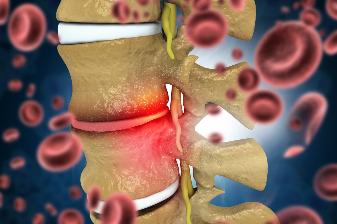 Medical illustration of an inflamed lumbar disc pressing on a nerve root, surrounded by red blood cells.
