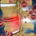 Medical illustration of an inflamed lumbar disc pressing on a nerve root, surrounded by red blood cells.
